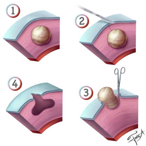 myom ameliyat uterus