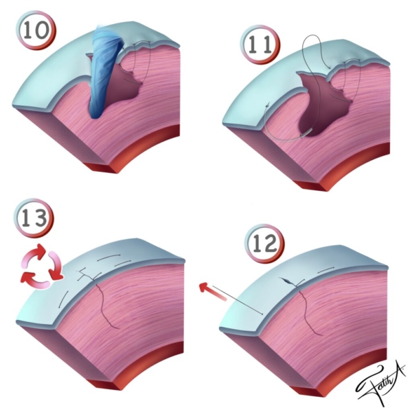 myom ameliyat uterus