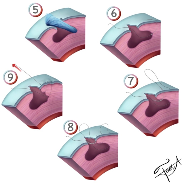 myoma surgery uterus